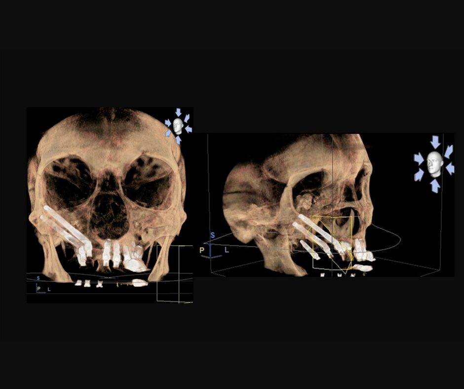 Reconstrucción 3D de colocación implantescigmáticos en paciente Clinica Torres Carranza