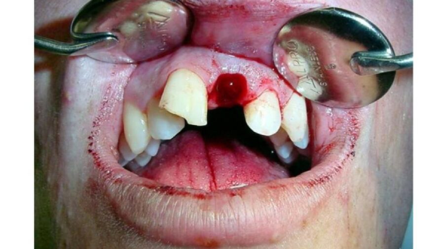 Pérdida incisivo tras traumatismo dental