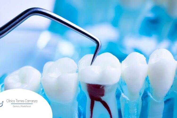 ¿Cuándo se realiza una endodoncia?