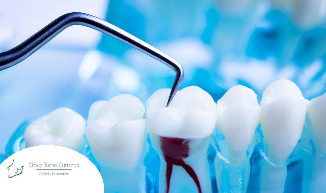 ¿Cuándo se realiza una endodoncia?