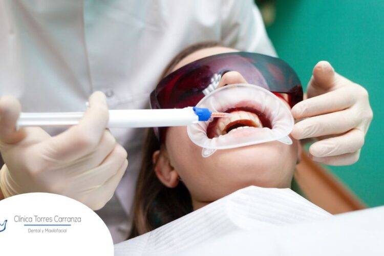 Blanqueamiento dental