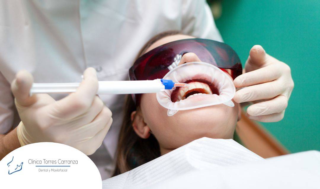 Blanqueamiento dental