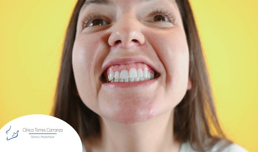 Acido hilauronico para la sonrisa gingival