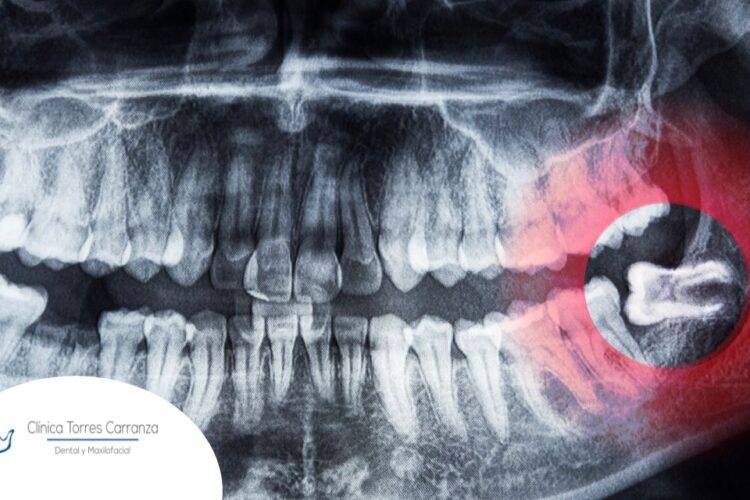 ¿Cómo saber si la muela del juicio está infectada?