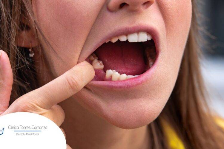 Todo sobre la alveolitis seca