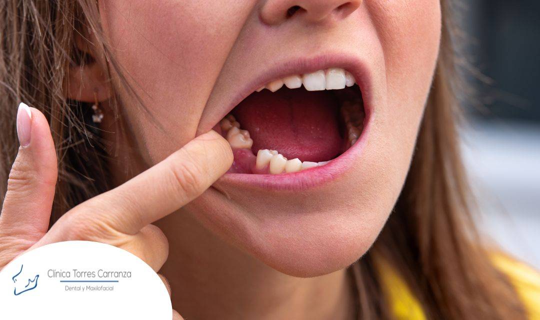 Todo sobre la alveolitis seca